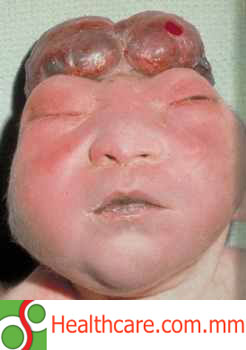 'Anencephaly' 