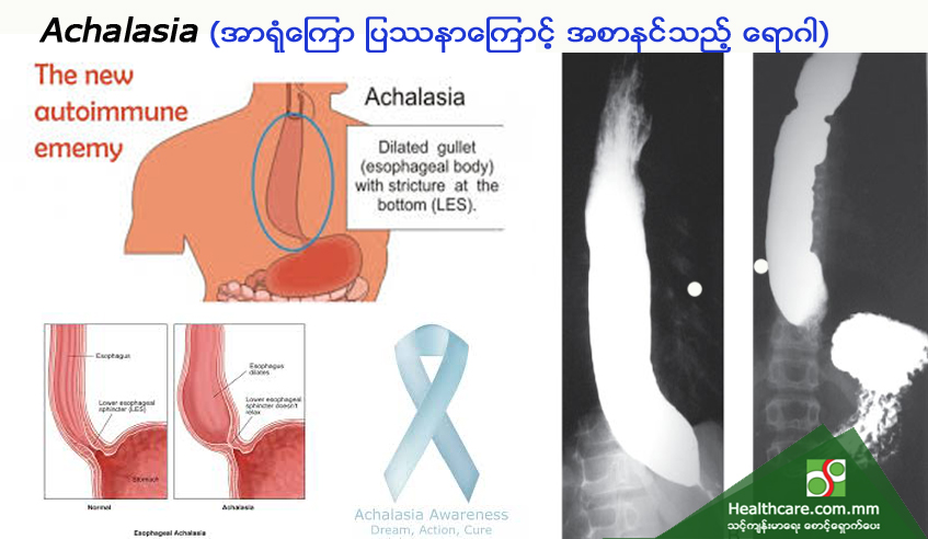 Achlasia (အာရုံကြော ပြဿနာကြောင့် အစာနင်သည့် ရောဂါ)