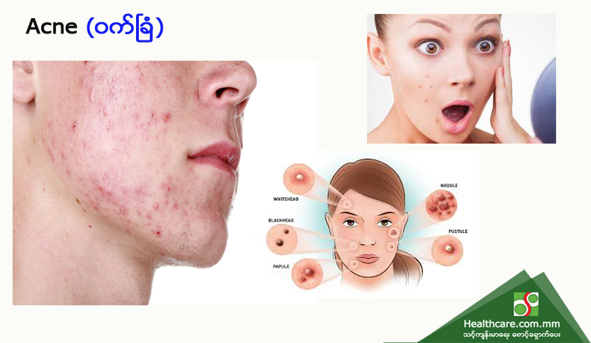 Acne (ဝက်ခြံ)