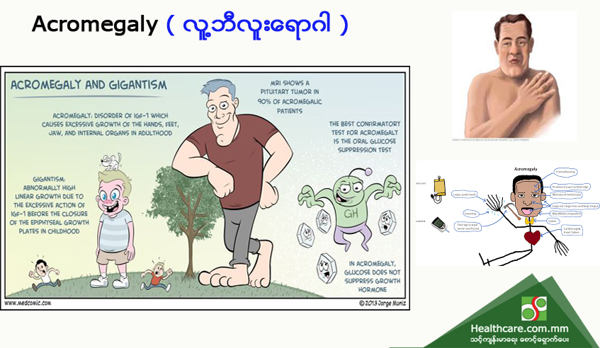 Acromegaly ( လူ့ဘီလူးရောဂါ )